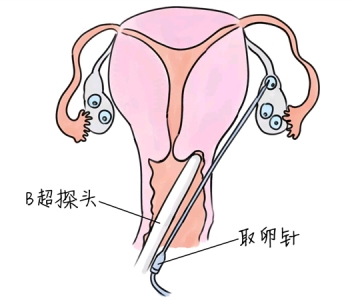 小儿退烧推拿手法 5种深圳捐卵宝宝退烧按摩方法